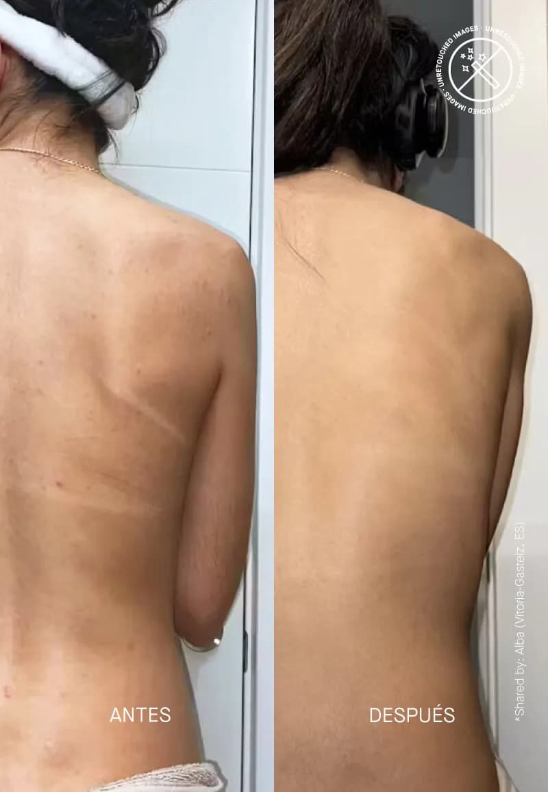 Acnemy Zitback® 80ml Спреј против акни на грб и тело 4
