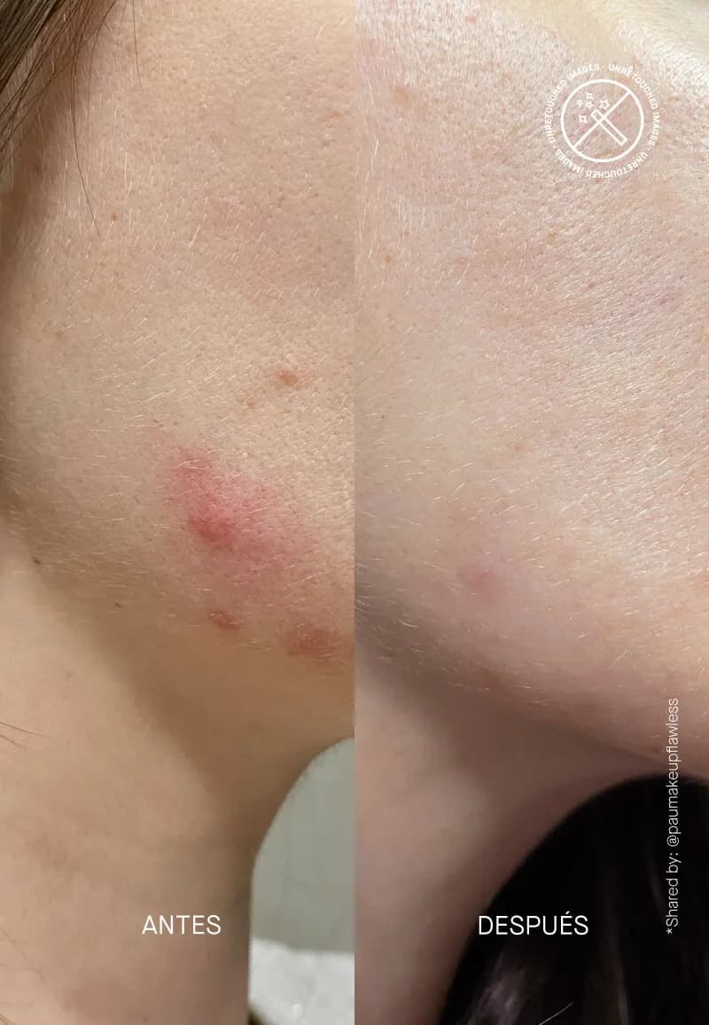 Acnemy Postzit® 30ml 4